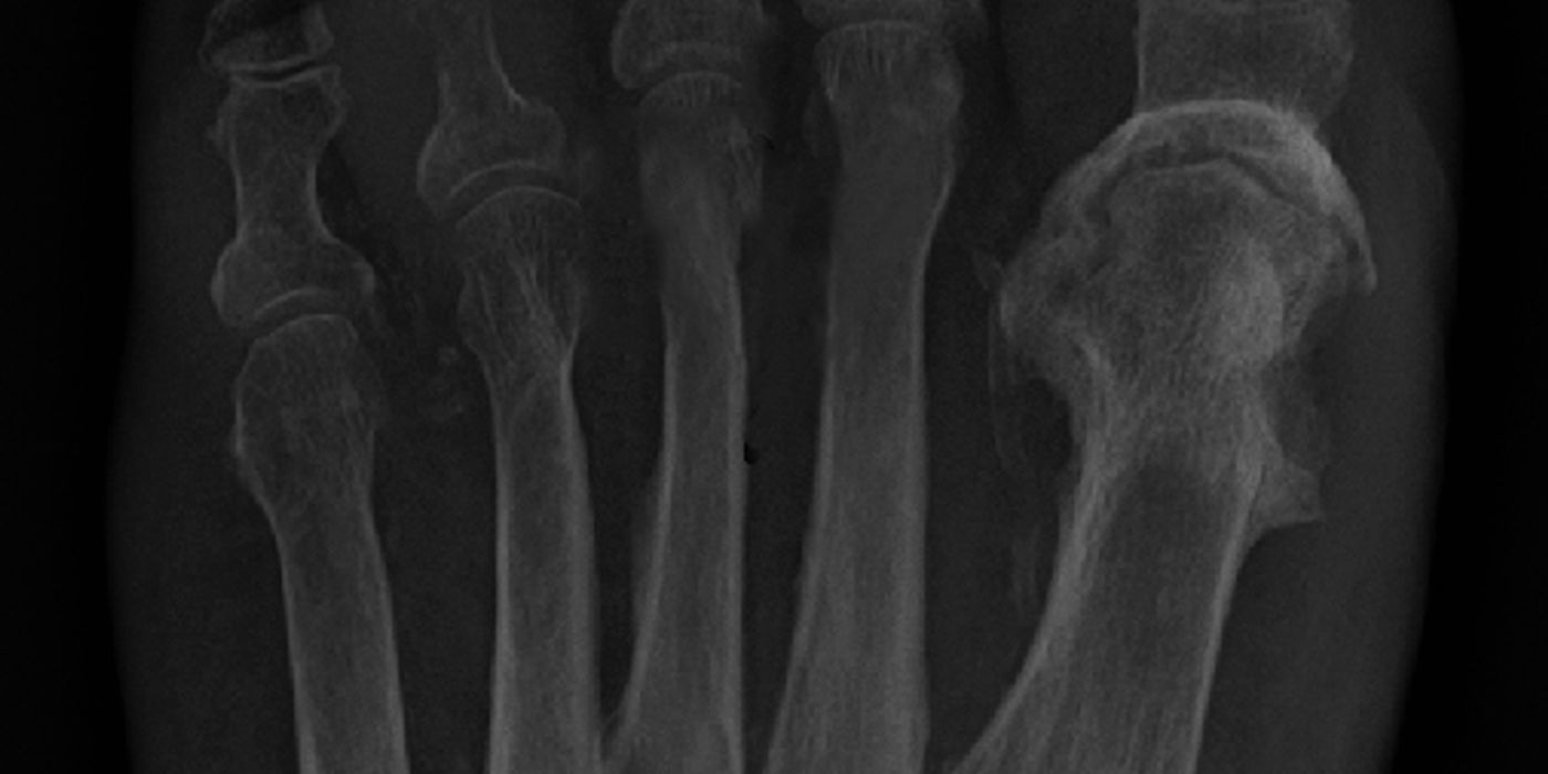 Fracture-Related Infection and Osteomyelitis — orthointerview.com