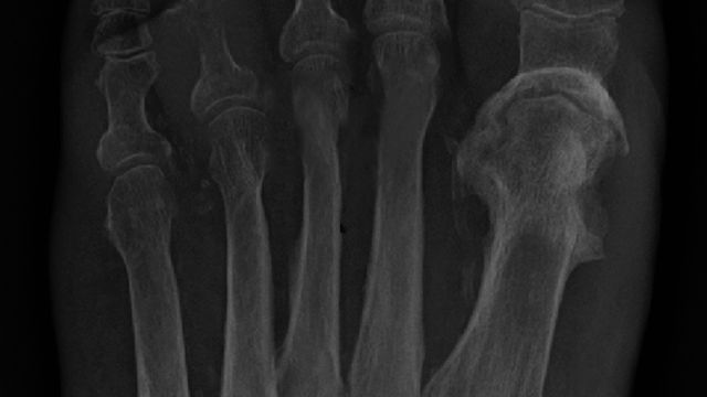 Fracture-Related Infection and Osteomyelitis — orthointerview.com
