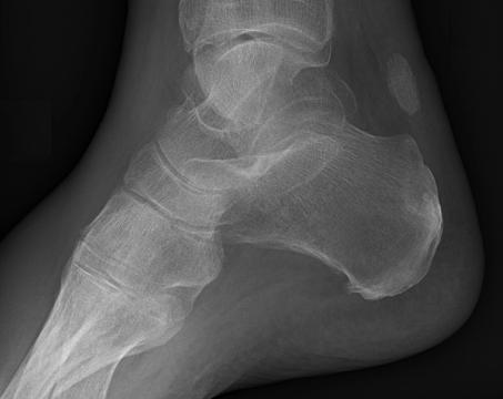 Hindfoot Fractures (Calcaneus and Talus): Diagnosis, Management and the Evidence — orthointerview.com