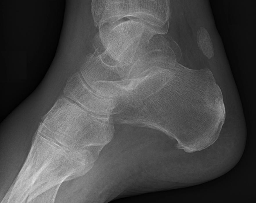 Hindfoot Fractures (Calcaneus and Talus): Diagnosis, Management and the Evidence — orthointerview.com