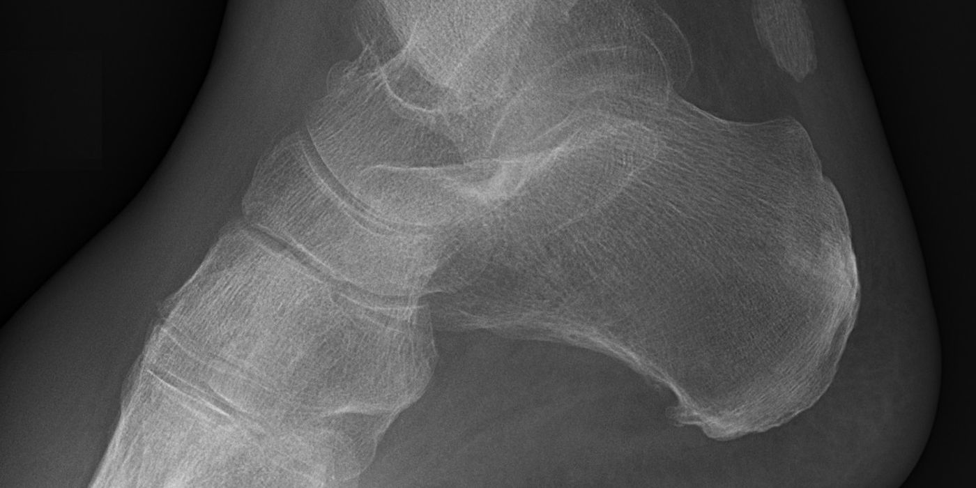 Hindfoot Fractures (Calcaneus and Talus): Diagnosis, Management and the Evidence — orthointerview.com