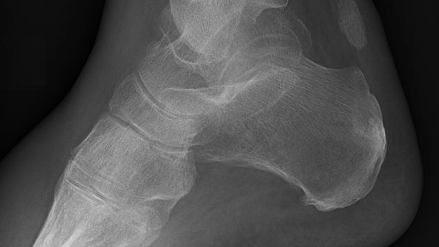 Hindfoot Fractures (Calcaneus and Talus): Diagnosis, Management and the Evidence — orthointerview.com