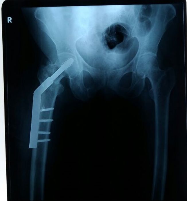 Dynamic Hip Screw: Principles and Technique — orthointerview.com