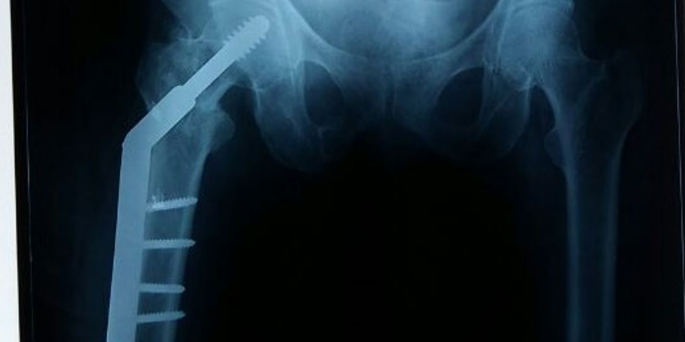 Dynamic Hip Screw: Principles and Technique — orthointerview.com