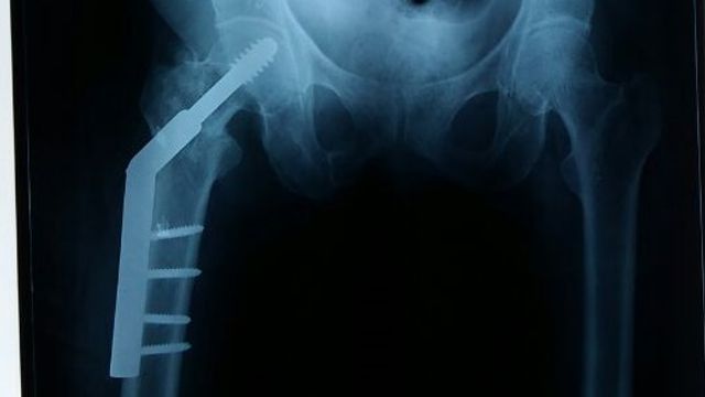 Dynamic Hip Screw: Principles and Technique — orthointerview.com