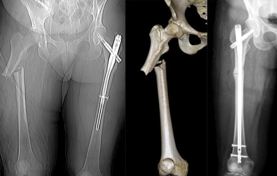 Femoral Shaft Fractures: Assessment, Nailing and Damage Control — orthointerview.com