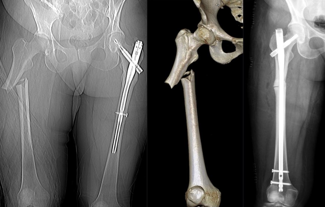 Femoral Shaft Fractures: Assessment, Nailing and Damage Control — orthointerview.com
