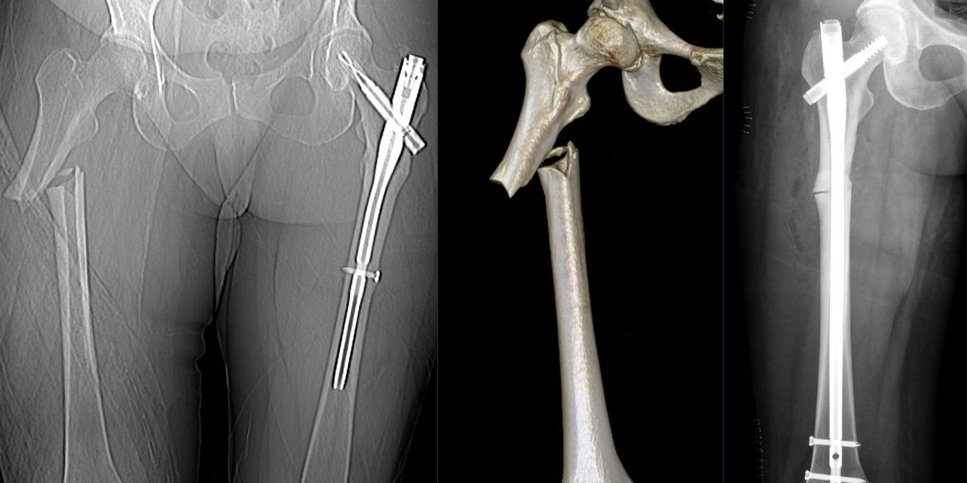 Femoral Shaft Fractures: Assessment, Nailing and Damage Control — orthointerview.com