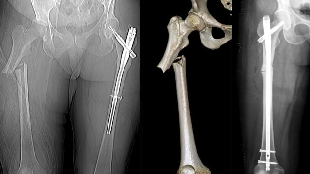 Femoral Shaft Fractures: Assessment, Nailing and Damage Control — orthointerview.com