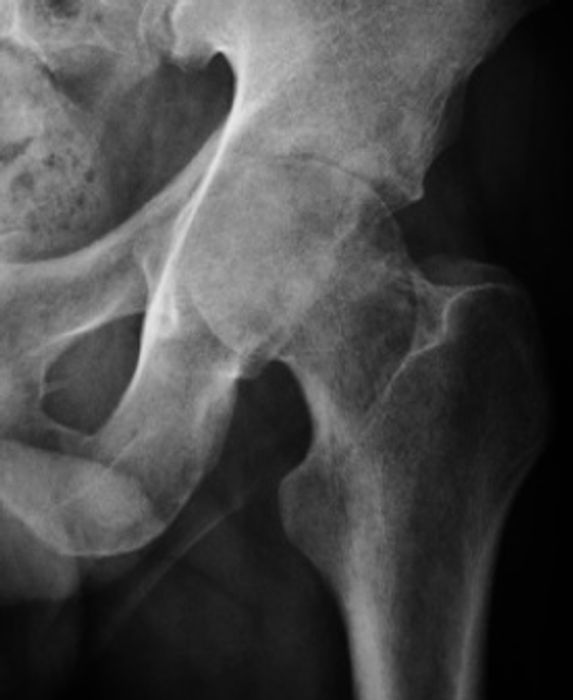 Septic Arthritis (Native Joint): Diagnosis and Management — orthointerview.com