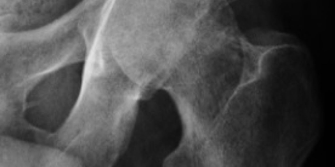 Septic Arthritis (Native Joint): Diagnosis and Management — orthointerview.com