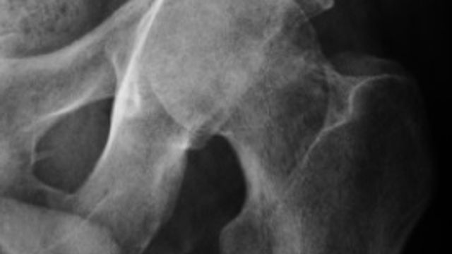 Septic Arthritis (Native Joint): Diagnosis and Management — orthointerview.com