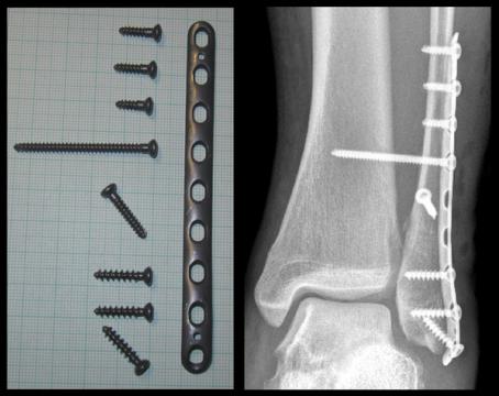 Ankle Fractures: Classification, Stability and Management (UK Guidelines) — orthointerview.com