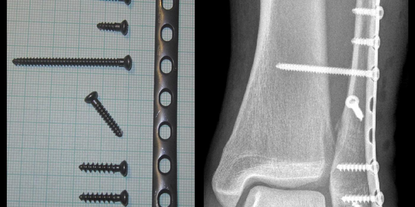 Ankle Fractures: Classification, Stability and Management (UK Guidelines) — orthointerview.com