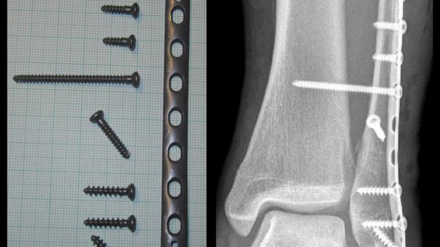 Ankle Fractures: Classification, Stability and Management (UK Guidelines) — orthointerview.com