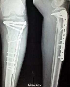 Lag Screw Fixation: Principles — orthointerview.com