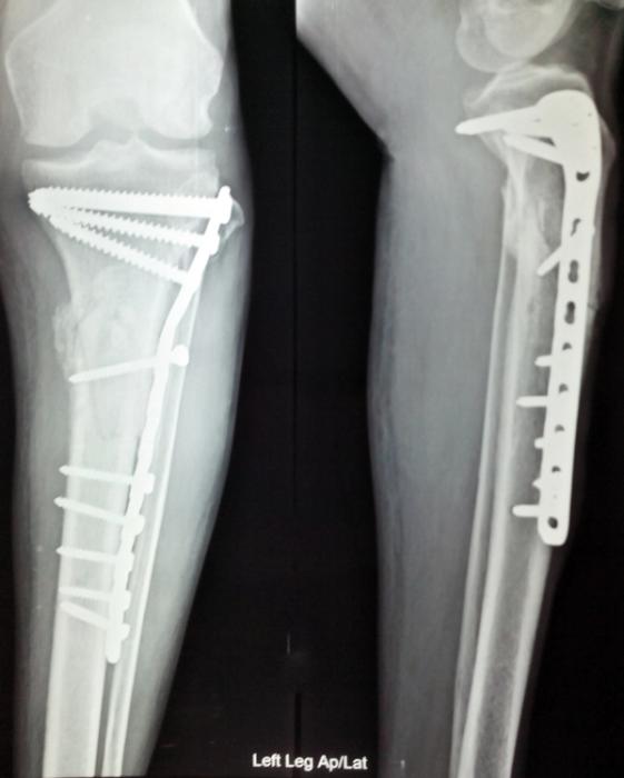 Lag Screw Fixation: Principles — orthointerview.com