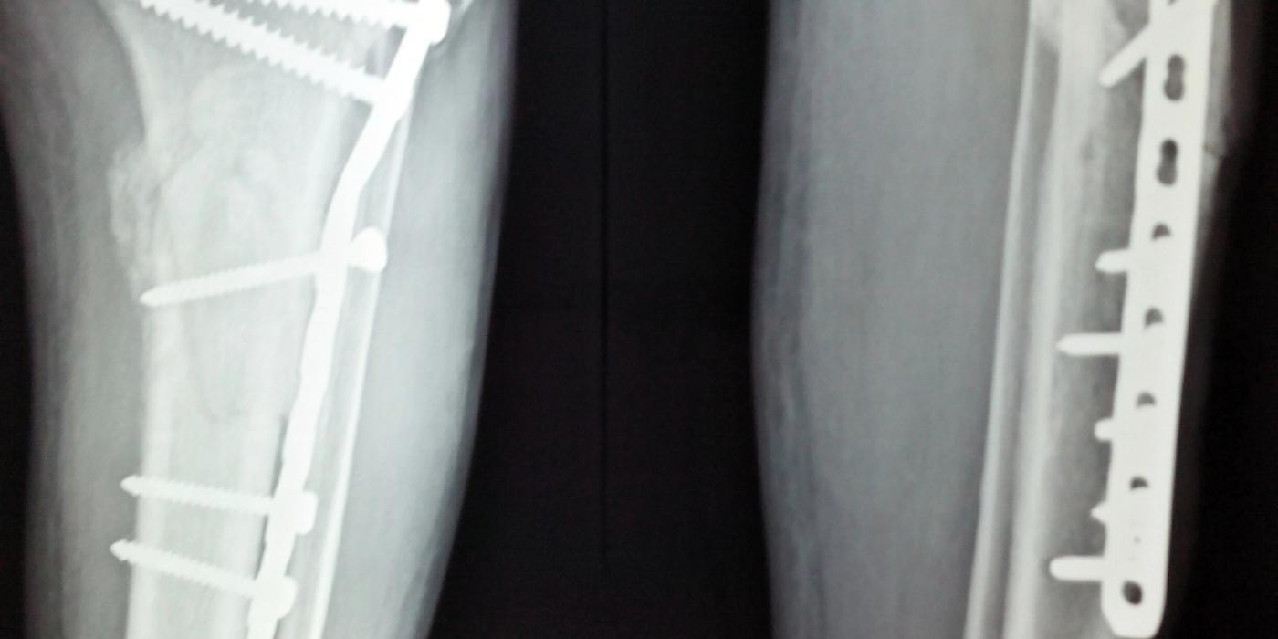 Lag Screw Fixation: Principles — orthointerview.com
