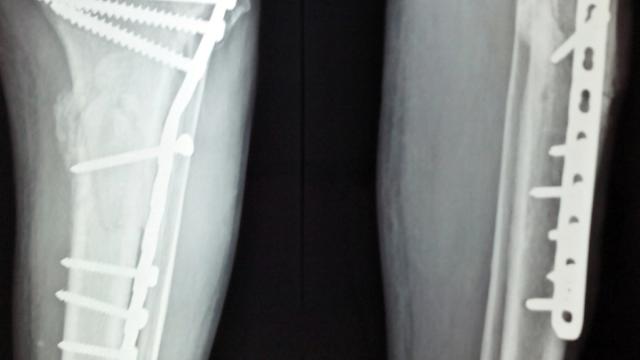 Lag Screw Fixation: Principles — orthointerview.com