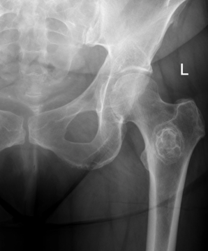 Metastatic Bone Disease: Diagnosis, Mirels Scoring and Management (BOAST 2022) — orthointerview.com