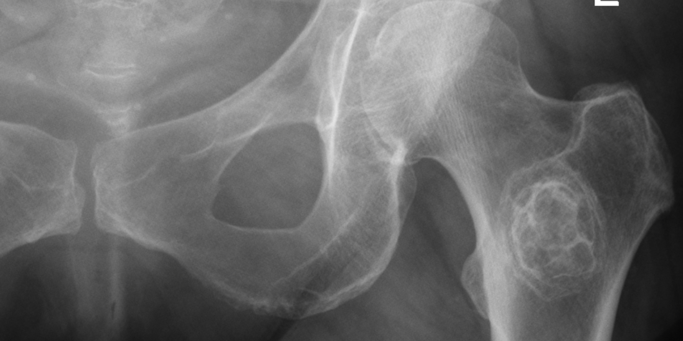 Metastatic Bone Disease: Diagnosis, Mirels Scoring and Management (BOAST 2022) — orthointerview.com