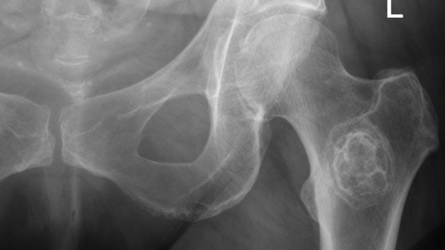 Metastatic Bone Disease: Diagnosis, Mirels Scoring and Management (BOAST 2022) — orthointerview.com