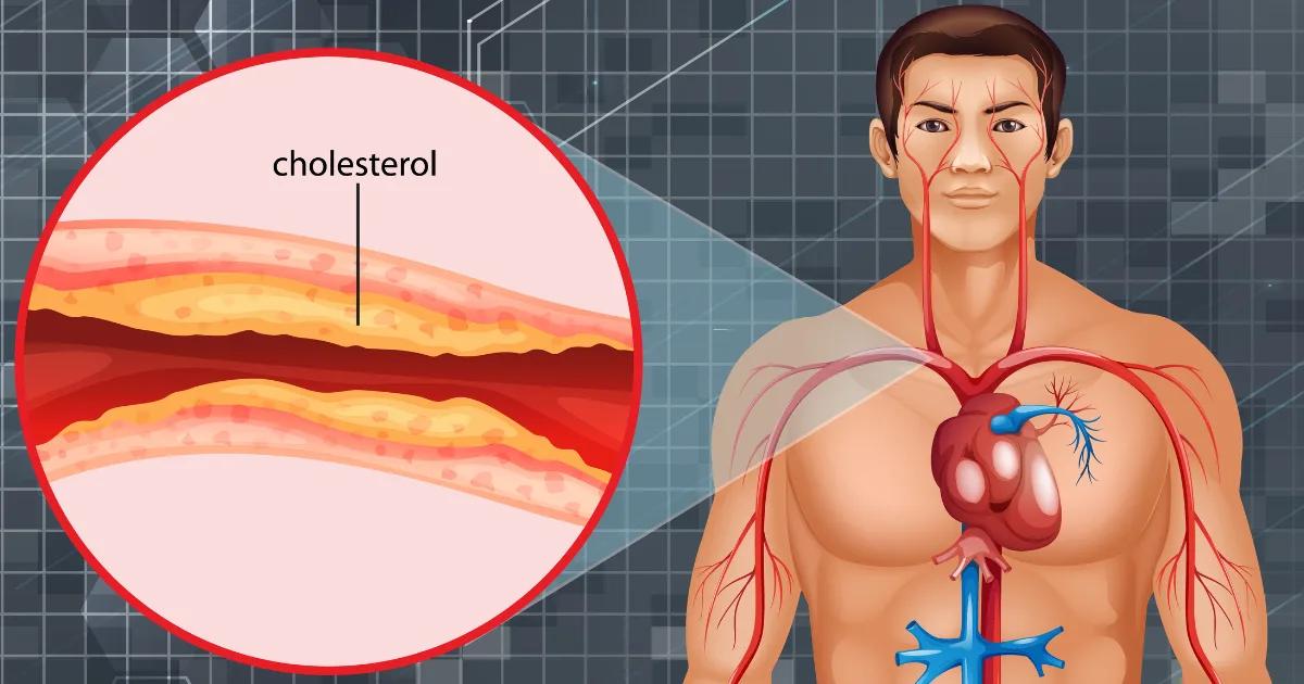 Symptômes d’hypercholestérolémie