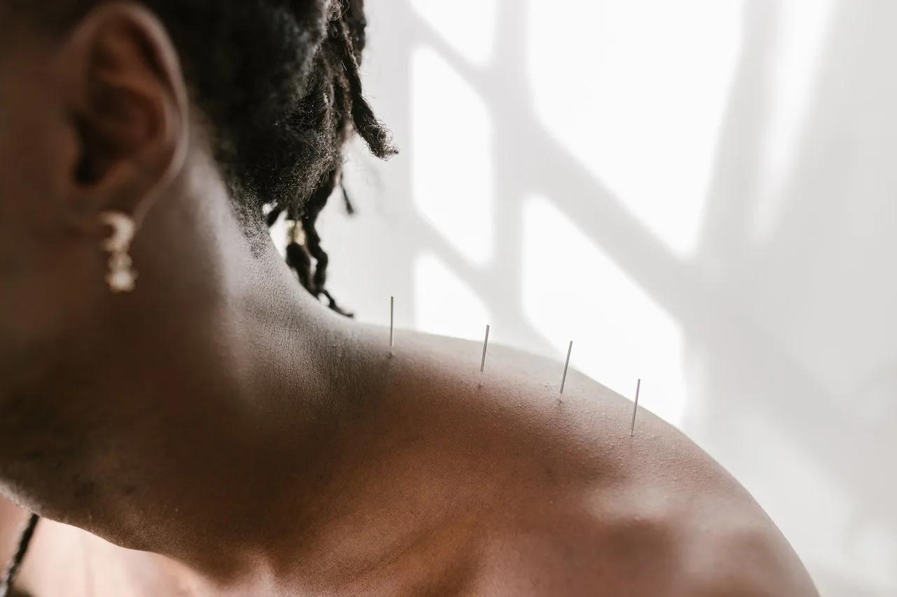L’acupuncture est le remède naturel contre l’anxiété que vous devriez essayer