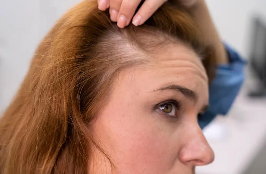 Comprendre la trichotillomanie : l’envie de s’arracher les cheveux