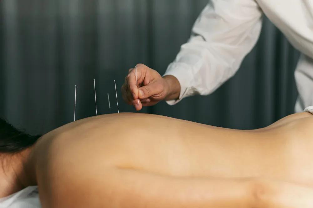 Améliorer sa santé et son bien-être avec l’acupuncture traditionnelle