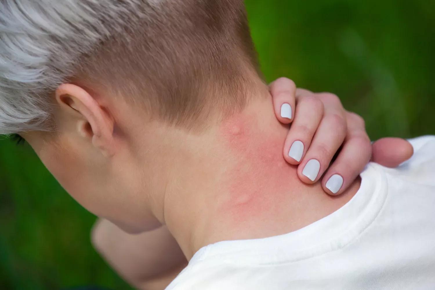 Éruptions cutanées et urticaire du au stress : ce qu’il faut savoir