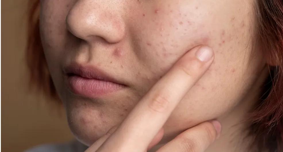 Qu’est-ce que l’acné due au stress et comment s’en débarrasser ?