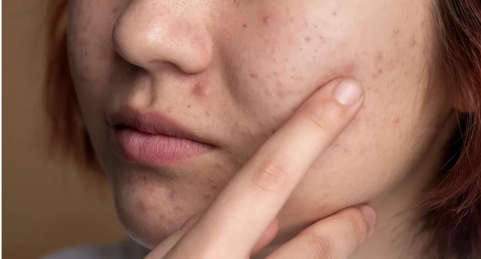Qu’est-ce que l’acné due au stress et comment s’en débarrasser ?