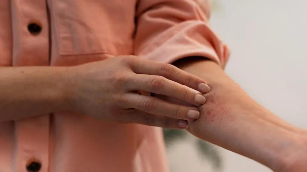 Eczéma et stress : Quel est le lien ?