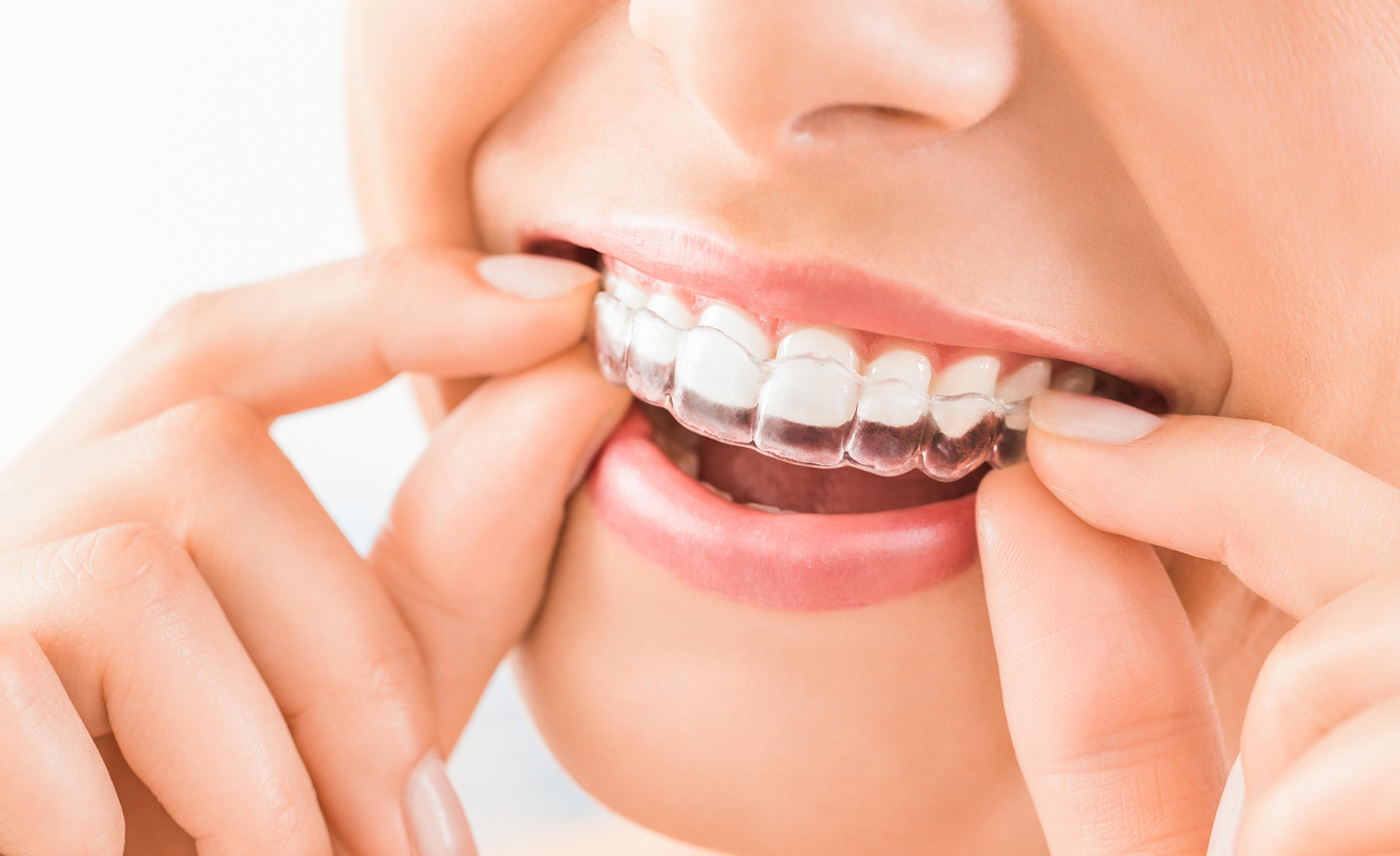 Patient holding a clear Invisalign aligner