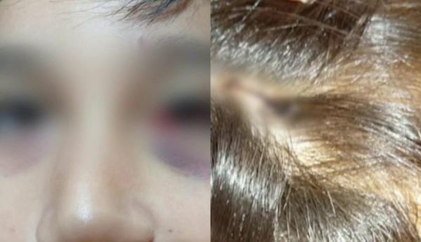 Un estudiante apuñaló con una lapicera a un compañero y le provocó una lesión en el ojo
