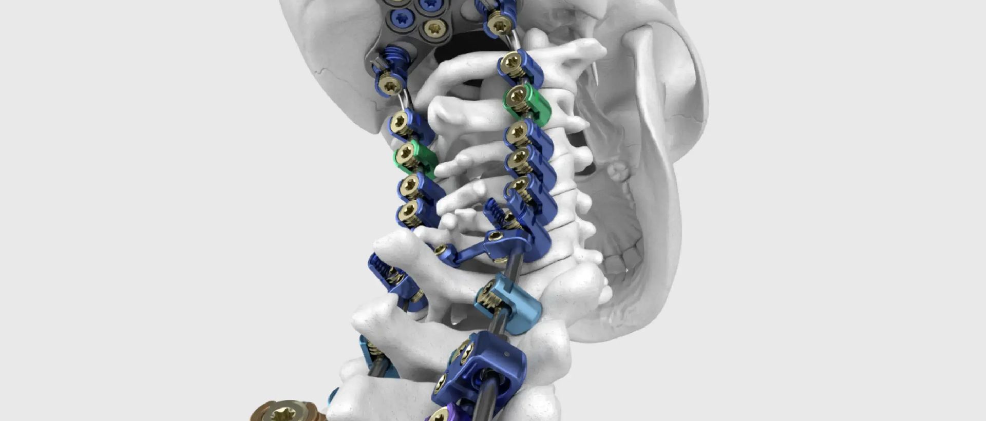 3D render of a color-coded occipitocervical spinal fixation system, with screws, rods, and an occipital plate on a skull and cervical spine