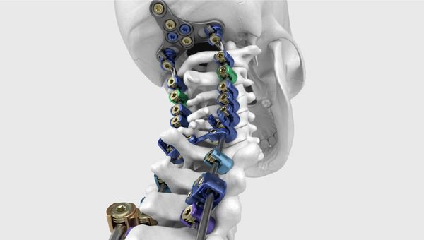 3D render of a color-coded occipitocervical spinal fixation system, with screws, rods, and an occipital plate on a skull and cervical spine