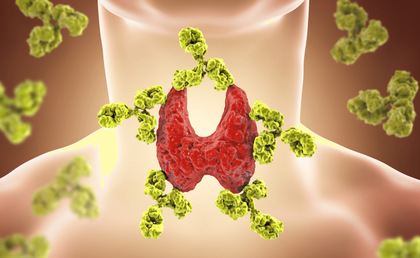 Tiroiditis de Hashimoto
