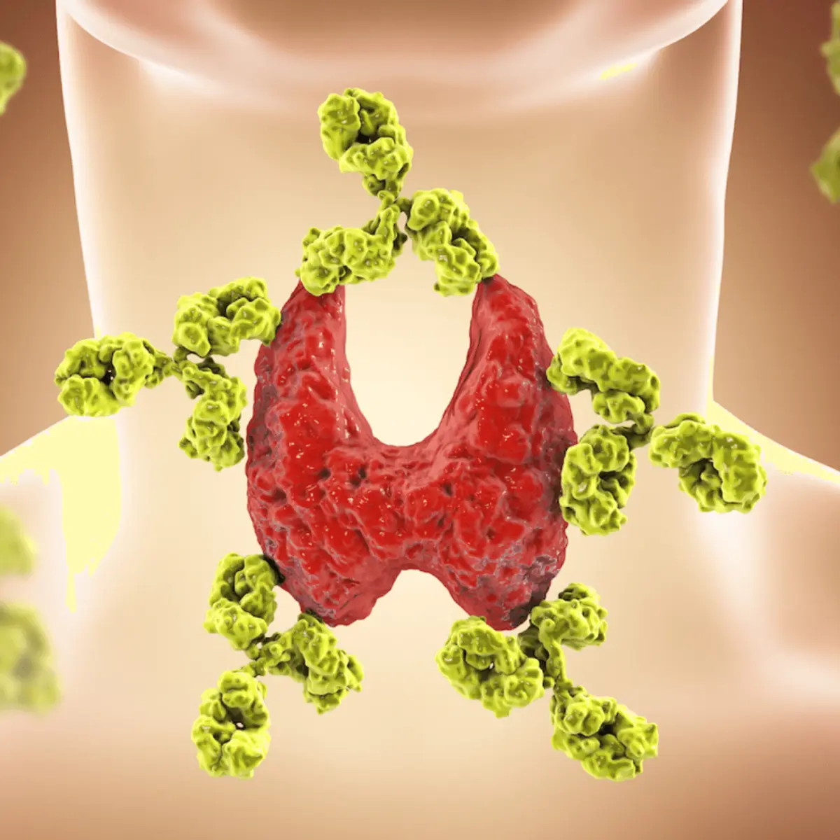 Tiroiditis de Hashimoto