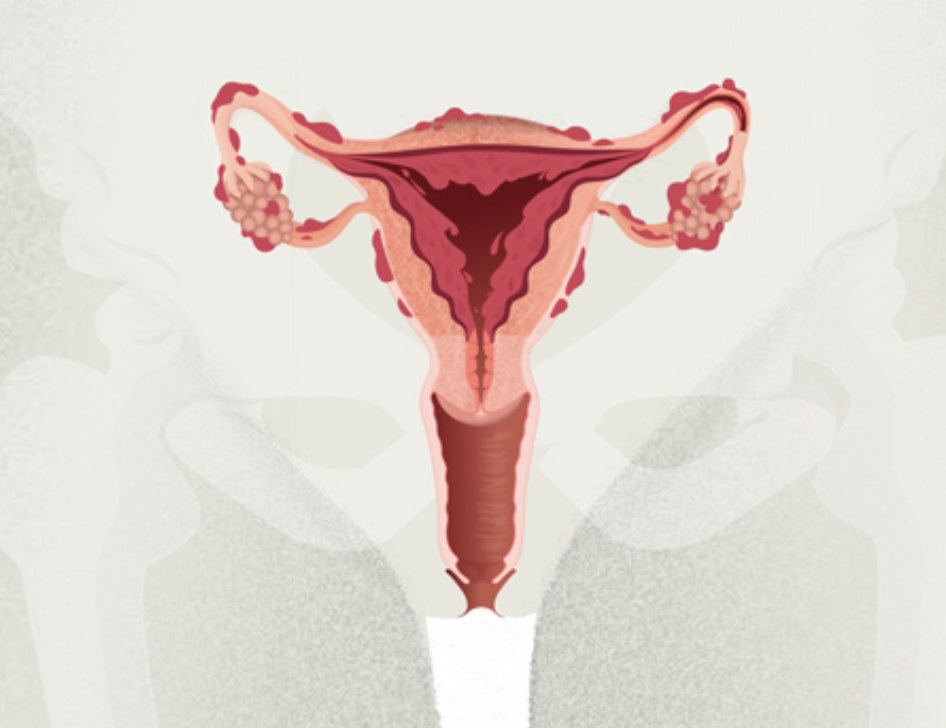 Endometriosis