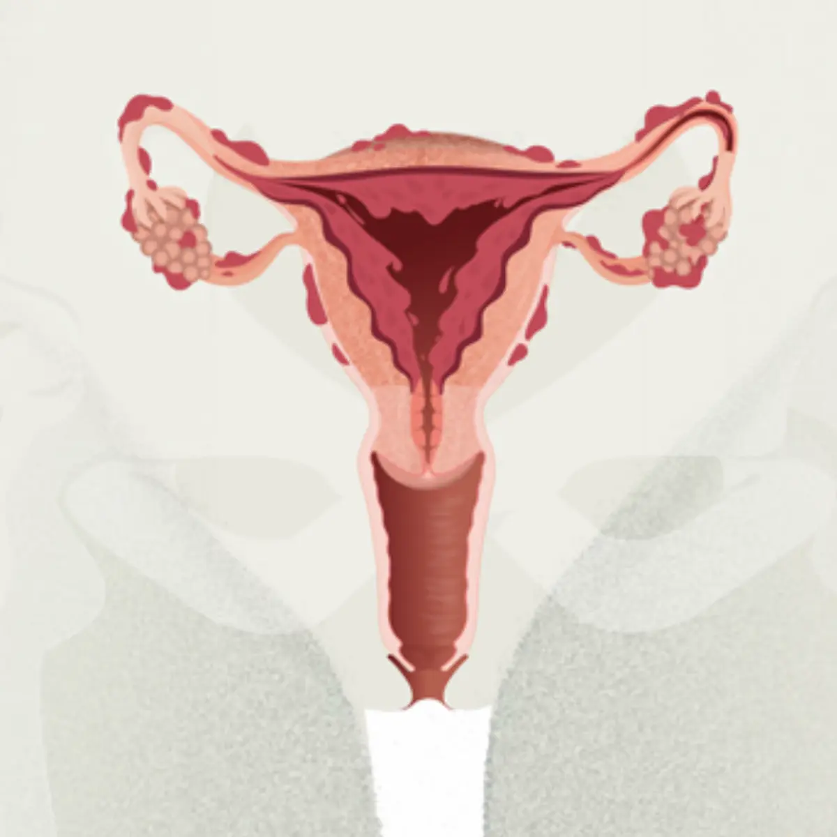 Endometriosis