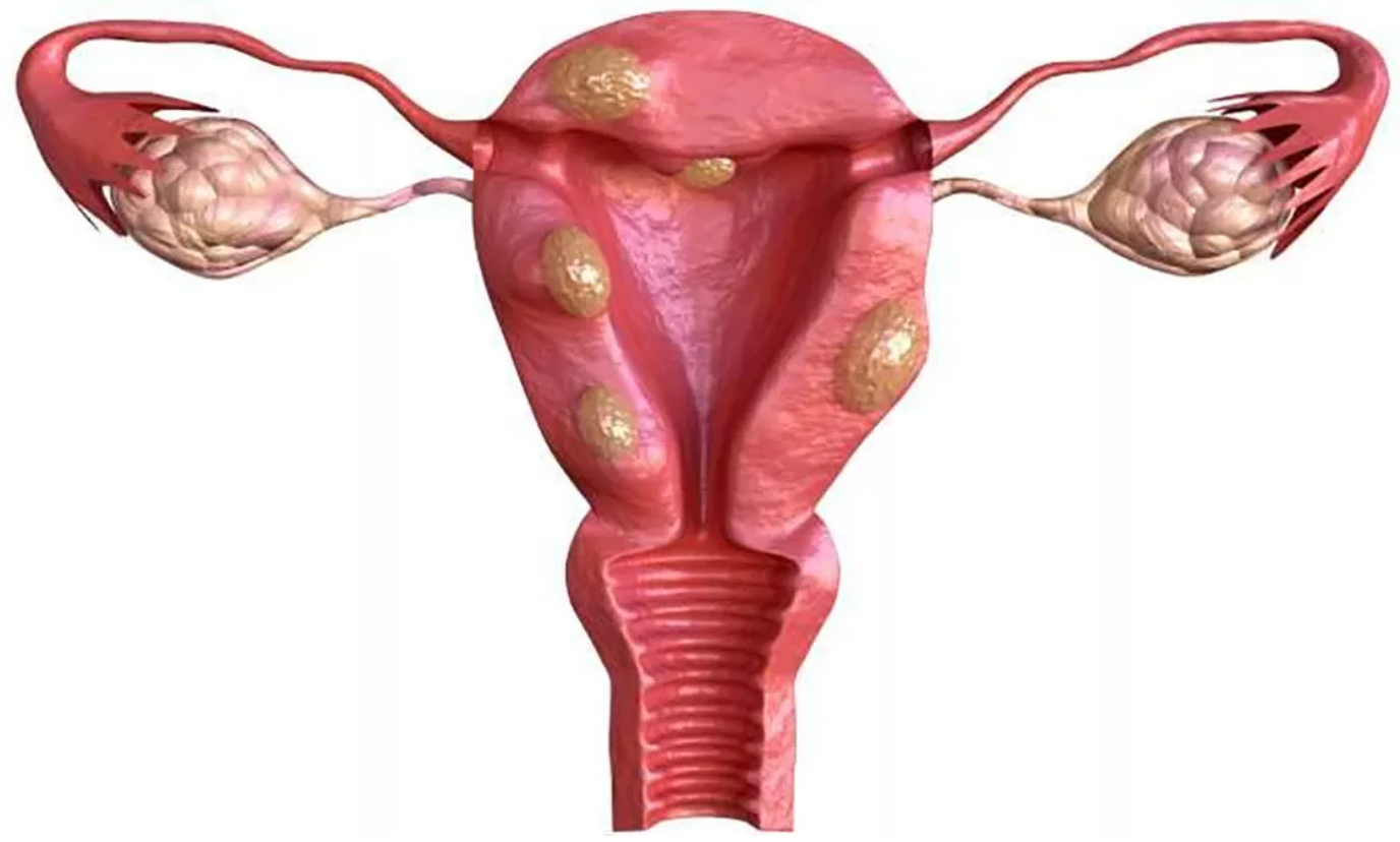 Miomas