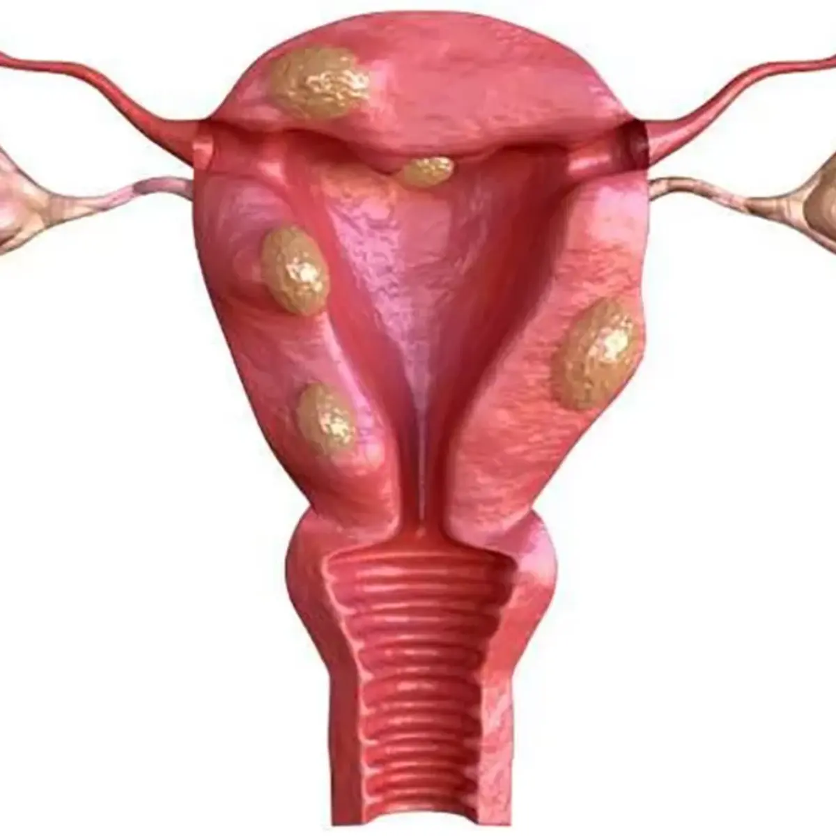Miomas