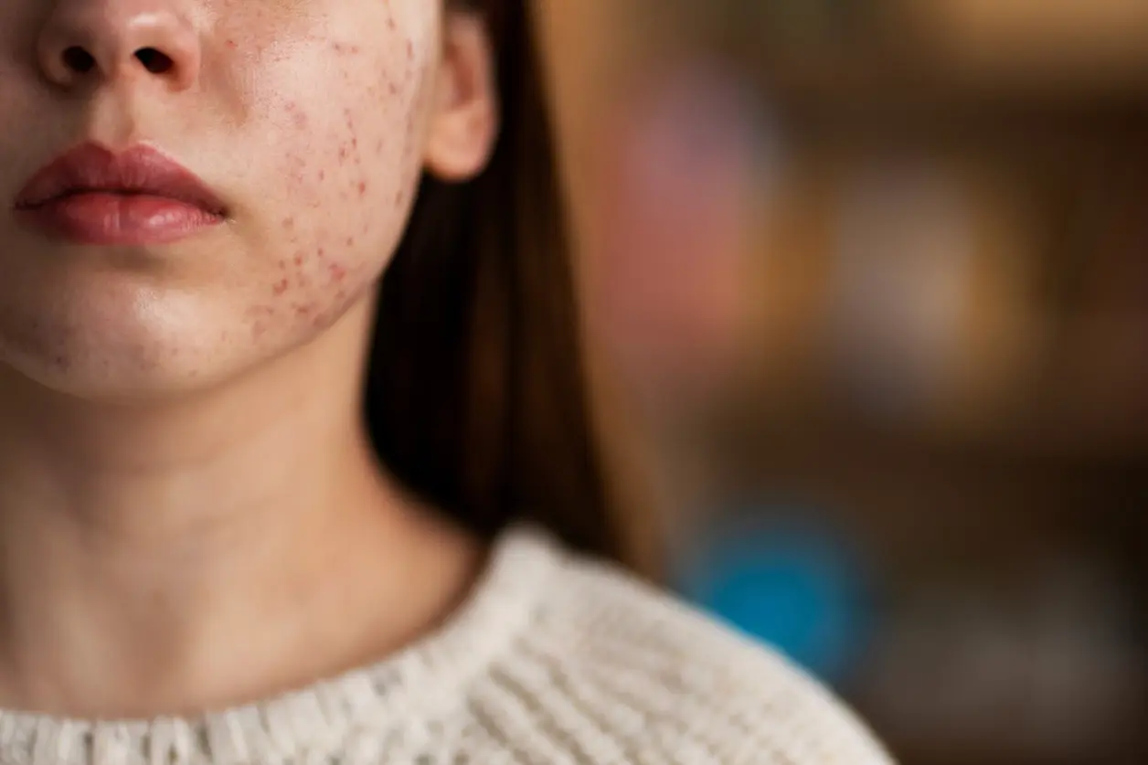 Mujer joven con acné en la mejilla y el mentón