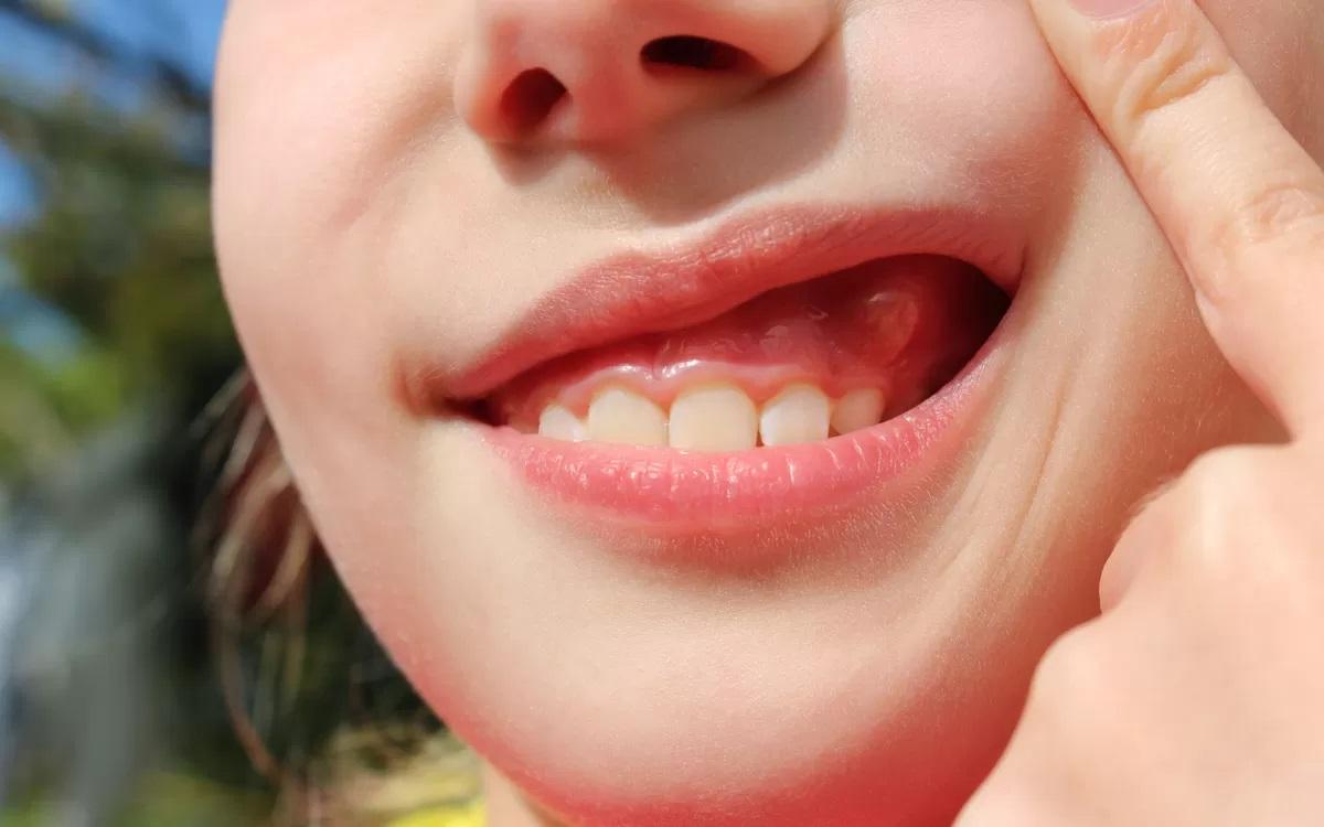 Ce antibiotice se recomandă pentru abces dentar?