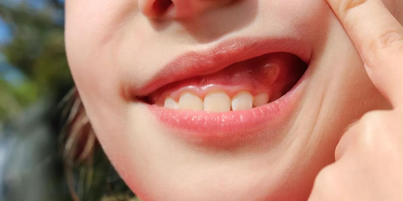 Ce antibiotice se recomandă pentru abces dentar?