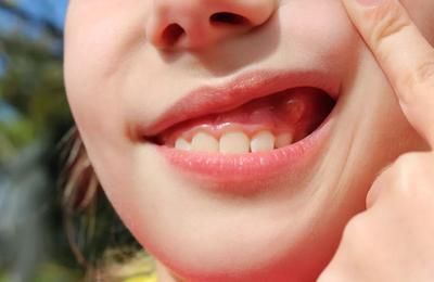 Ce antibiotice se recomandă pentru abces dentar?