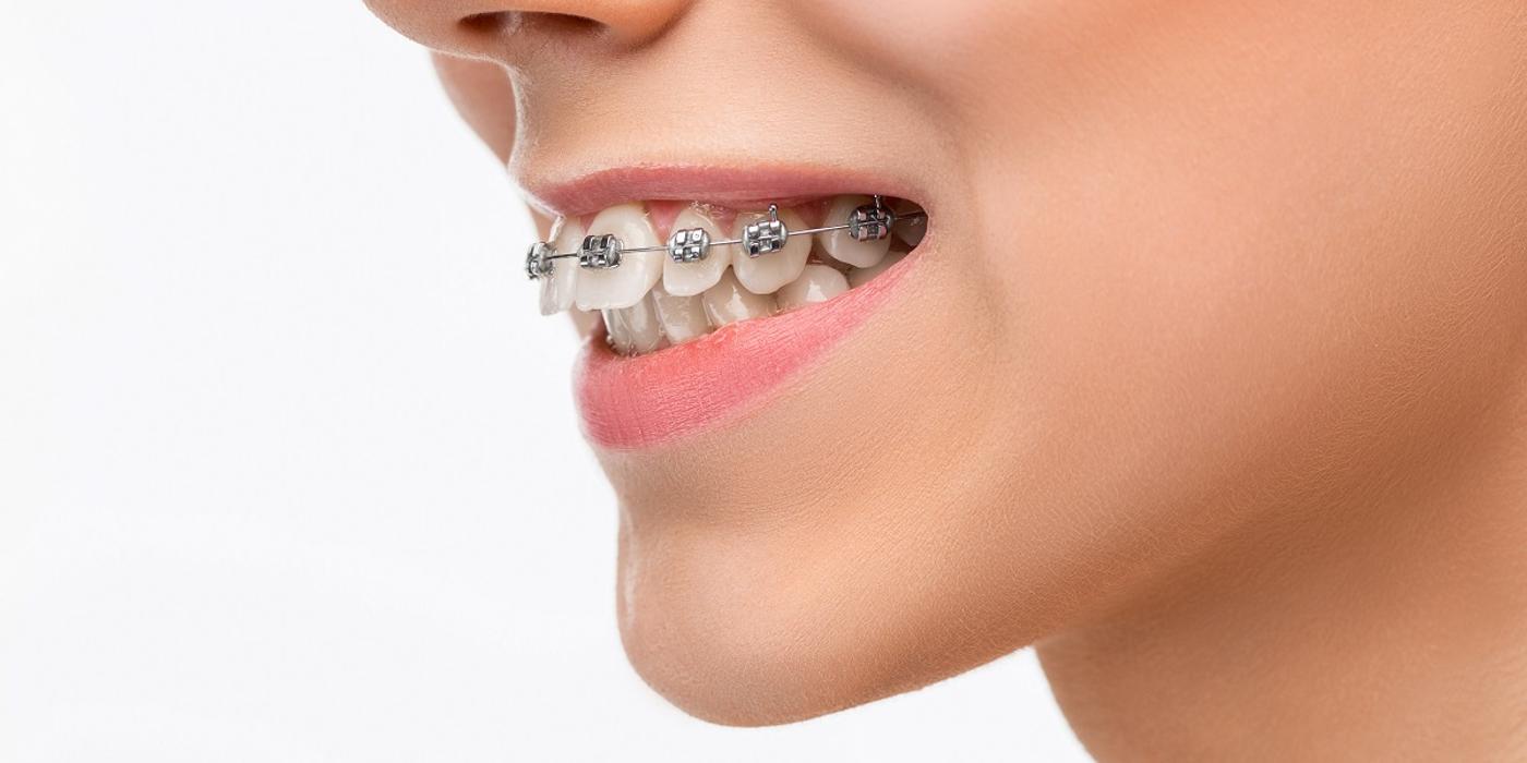 Cum să îți îngrijești dinții în timpul tratamentului ortodontic