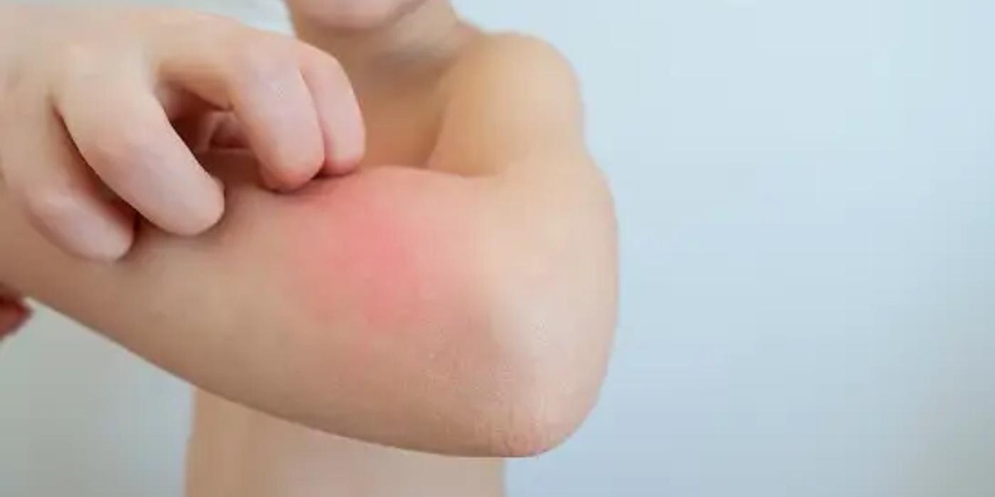 Mușcătura de căpușă la copii: Soluții de prim ajutor